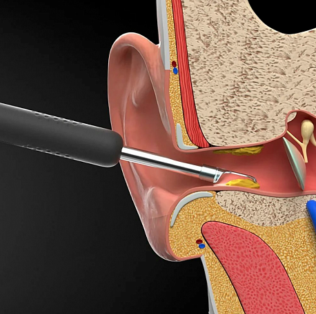 Умная ушная палочка Xiaomi Bebird Smart Visual Spoon Ear Stick R1